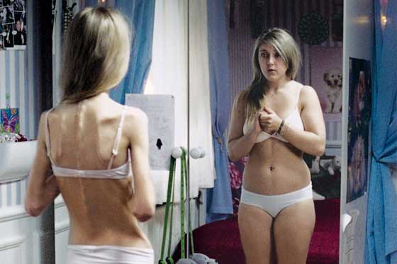 Bulimia or Imperfection. Anorexia