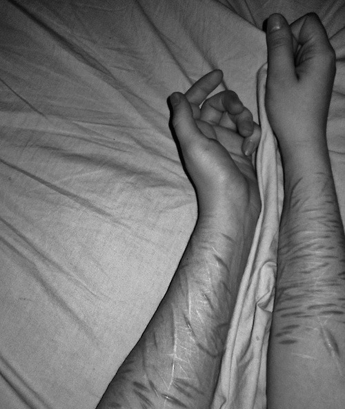 Emo Cuts On Arm Bleeding