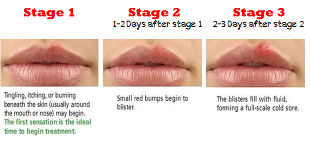 oral-sex-cold-sore